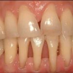 десны оголяются корни зубов