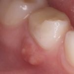 гнойный прыщ на десне