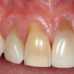 голые корни зубов