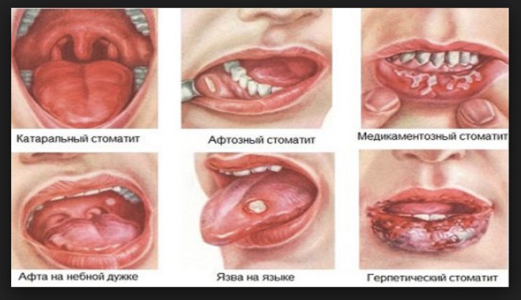 Хлорофиллипт при воспалении десны