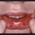 холисал гель стоматологический 15г