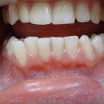 калгель при зубной боли