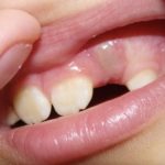 массаж десен при пародонтите