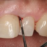 массаж десен при пародонтозе