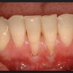 оголение корней зубов