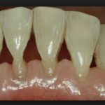 оголение корней зубов лечение