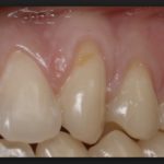 оголились корни нижних зубов