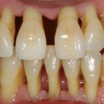 оголился корень зуба