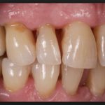 оголяются корни верхних зубов