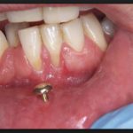 оголяются корни зубов что делать