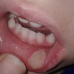 пародонтоцид гель для детей