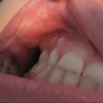 пародонтоцид гель при беременности