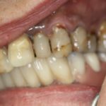 пародонтоцид гель при гингивите