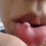 пародонтоцид гель при стоматите