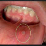 применение геля холисал