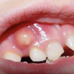 прыщ на десне не болит