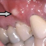 прыщик на десне