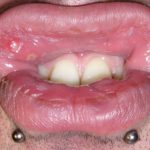 рана на десне фото