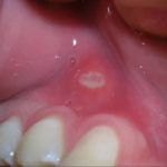 ранка на десне