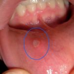 ранка на десне фото