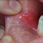 ранки на деснах возле зубов