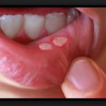 стоматологический гель холисал