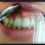 вакуумный массаж десен