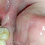 Болит десна после удаления зуба