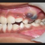 Что делать с синей десной