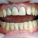 фиолетовые десны