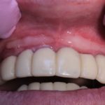 на десне болит белый рубец