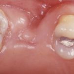 неделю болит десна после удаления зуба