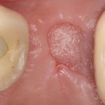 почему болит десна после удаления зуба