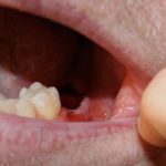 после удаление зуба болит десна опухла