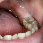 после удаления коренного зуба болит десна