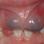 причины фиолетовых десен