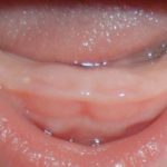 рубец на десне