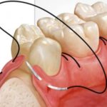 рубец на десне источник инфекции