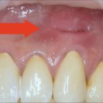 рубец в десне