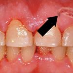 жжение в области рубца на десне