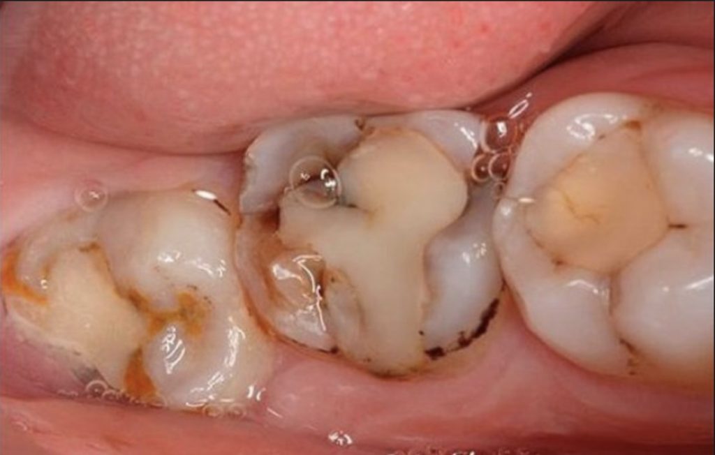 Болит зуб и опухла десна что делать после пломбирования