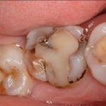 Опухла десна на зубе после пломбирования