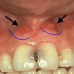 чем полоскать свищ на десне