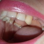 десны провалились