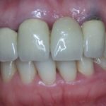 гематома на десне