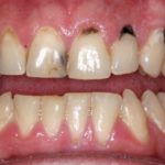 гематома на десне у взрослых