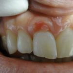 как вылечить свищ на десне