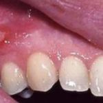 мазь от свища на десне