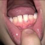 на десне появился синяк