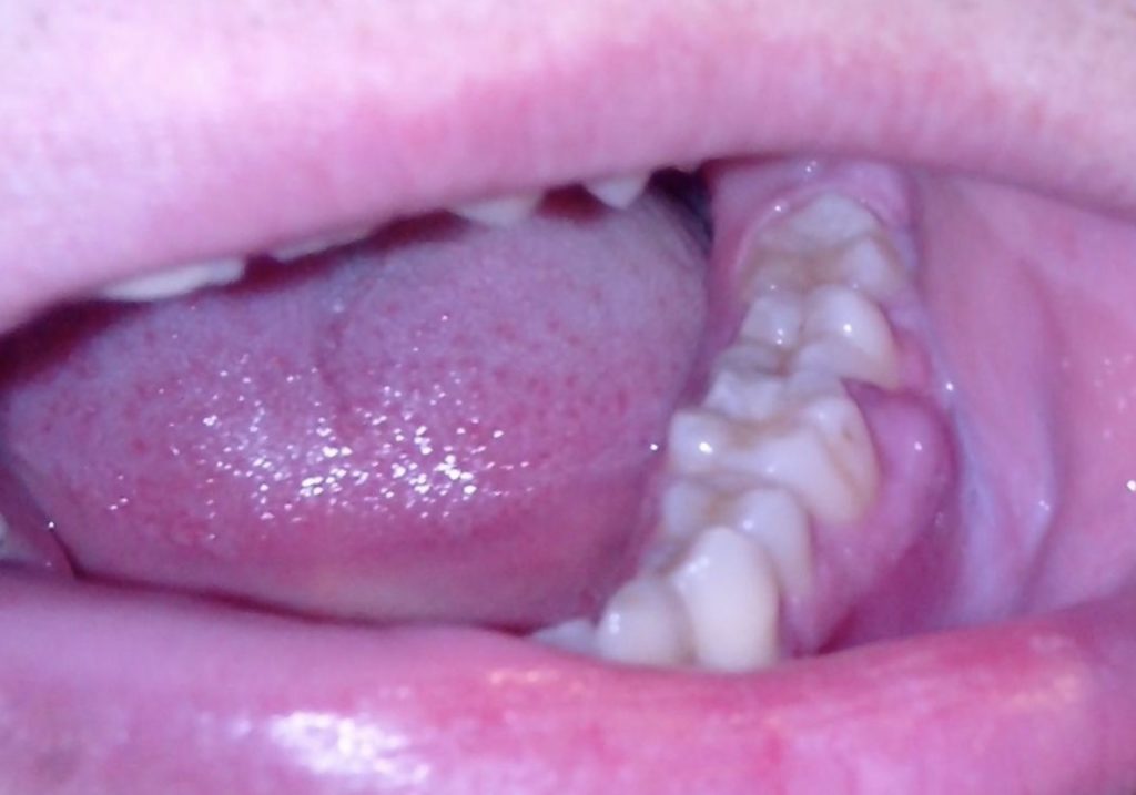 Болит зуб и опухла десна что делать после пломбирования
